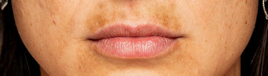 rosto com melasma